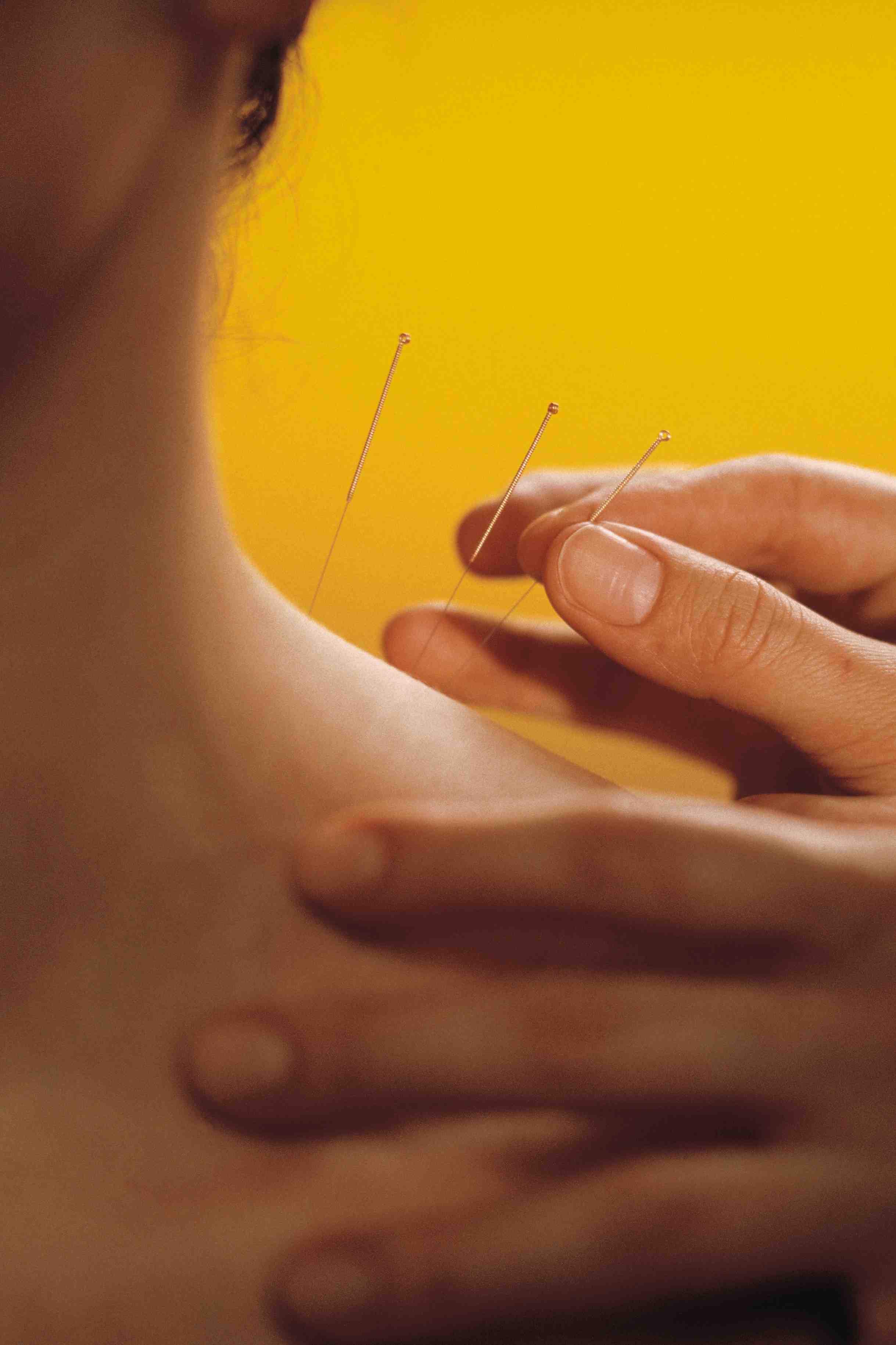 Acupuntura, una buena noticia para los odontofóbicos