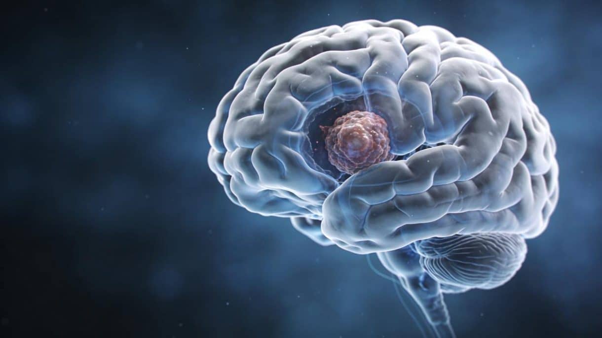 Las infusiones que podrían ayudar a prevenir un tumor cerebral