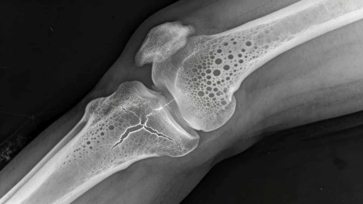 Medicamentos para la osteoporosis