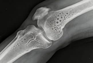 Medicamentos para la osteoporosis