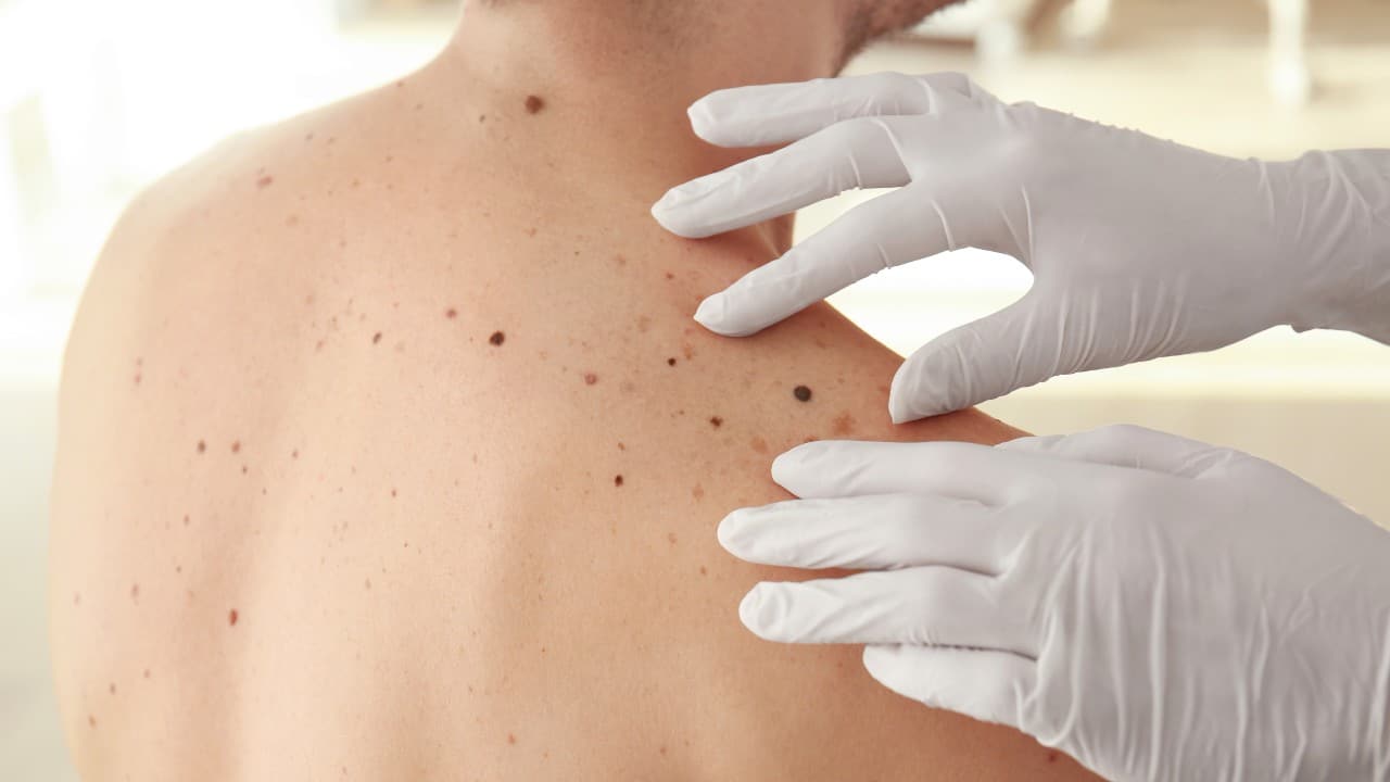 Un medicamento nuevo contra el melanoma