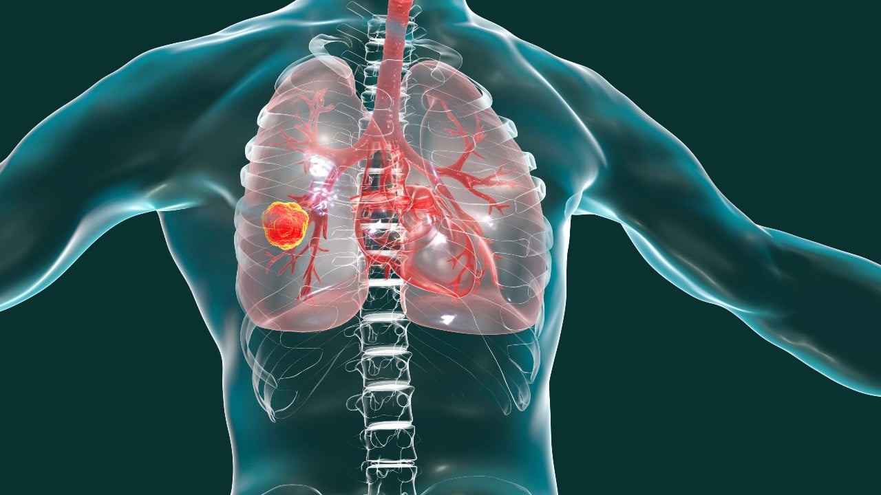 Protégete del cáncer del pulmón… ¡apaga ese cigarrillo!