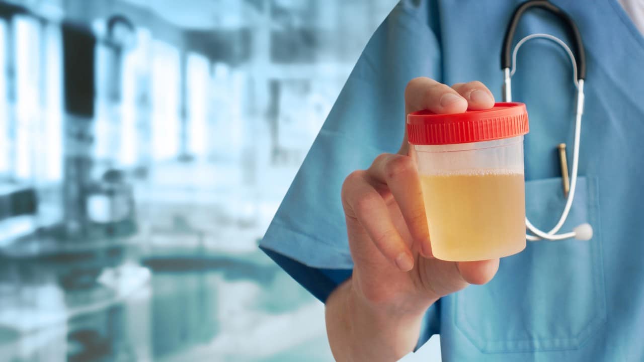Prueba de orina detectaría riesgo de declive mental en pacientes con diabetes tipo 2