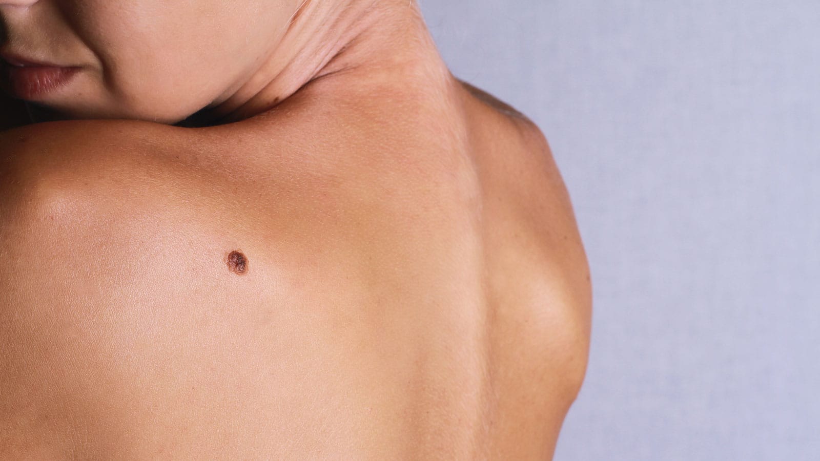 melanoma