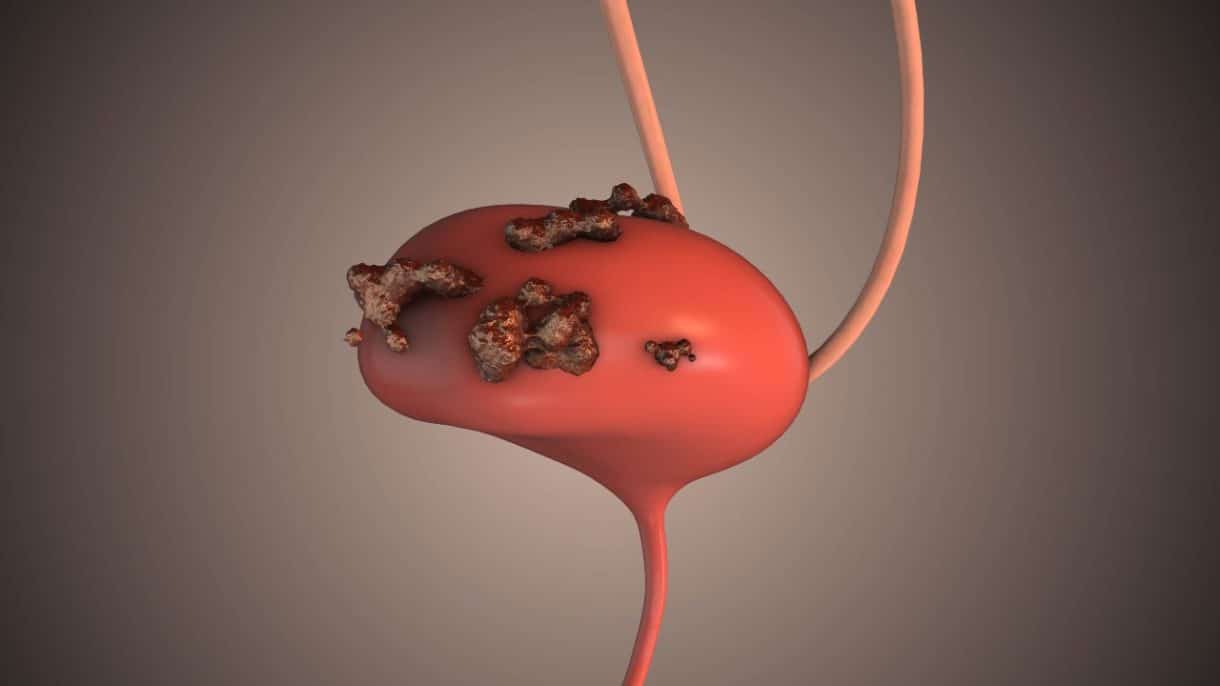 Cáncer de la vejiga: síntomas y factores de riesgo