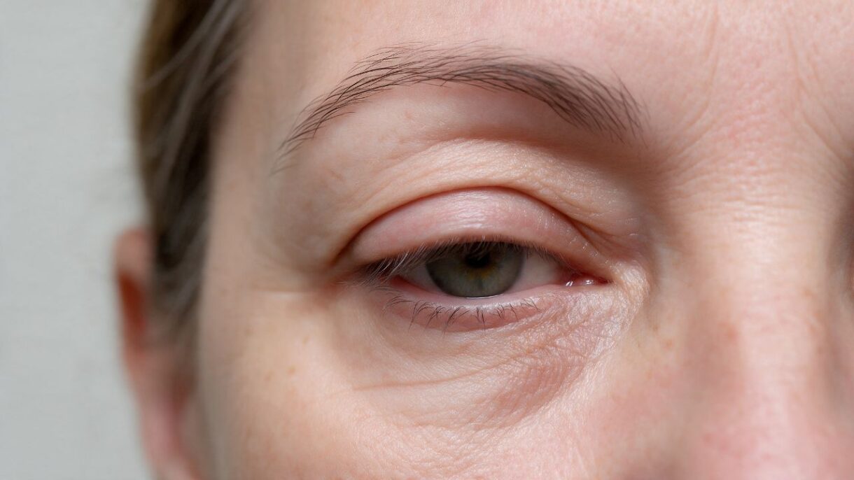 Párpado caído (Ptosis)