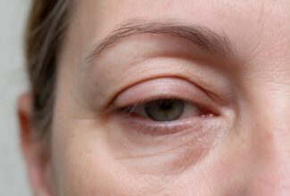 Párpado caído (Ptosis)
