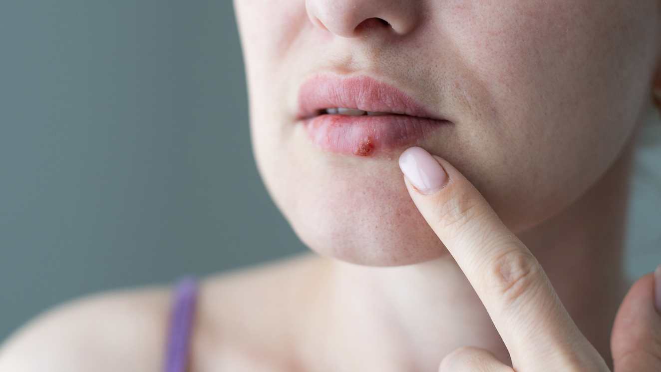 Culebrilla (Herpes zóster)