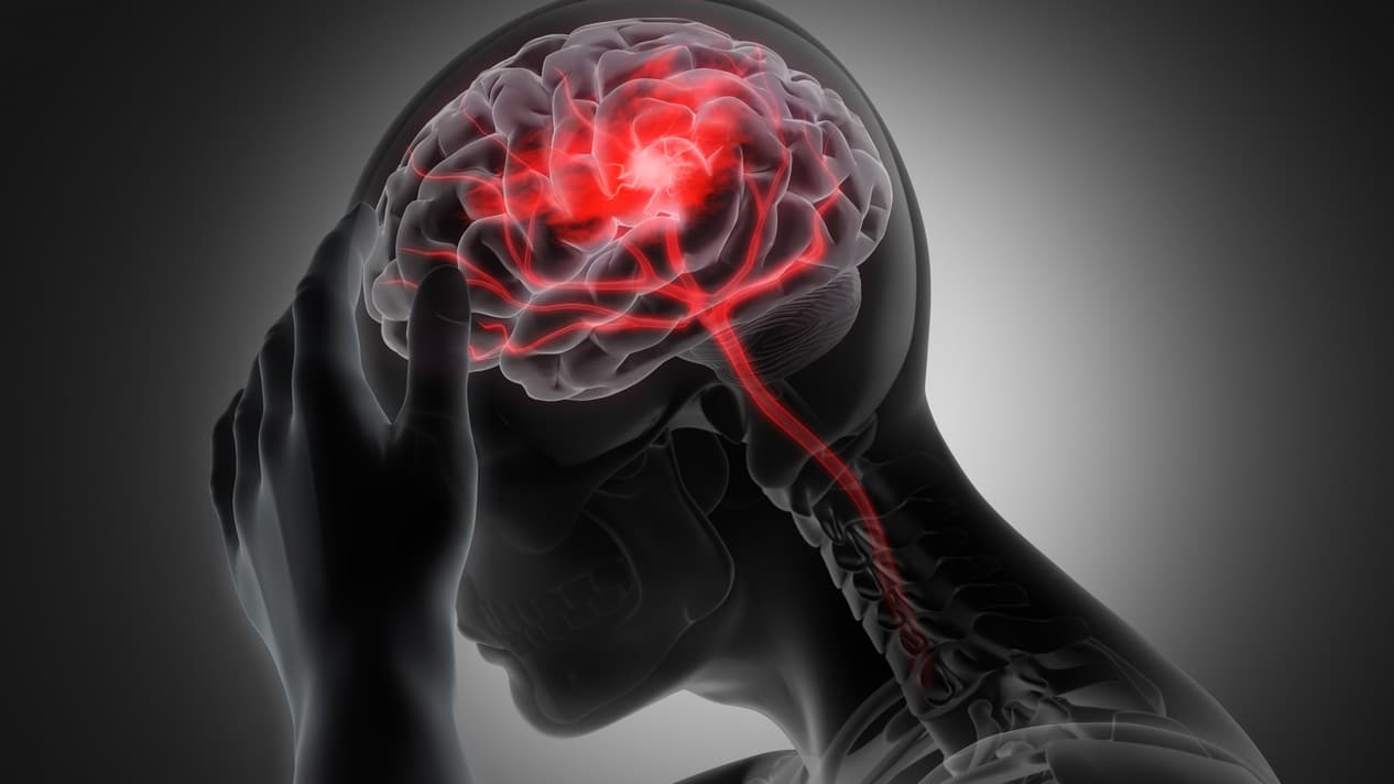 Accidente Cerebrovascular o Apoplejía