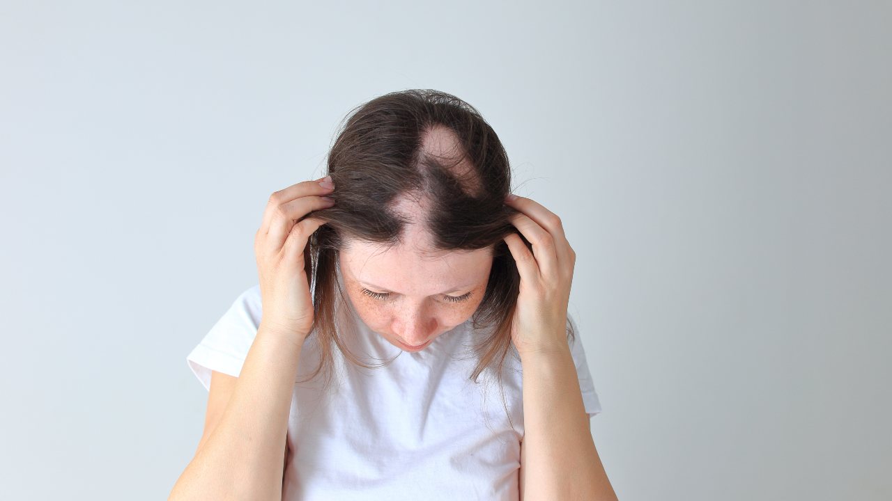Alopecia Areata
