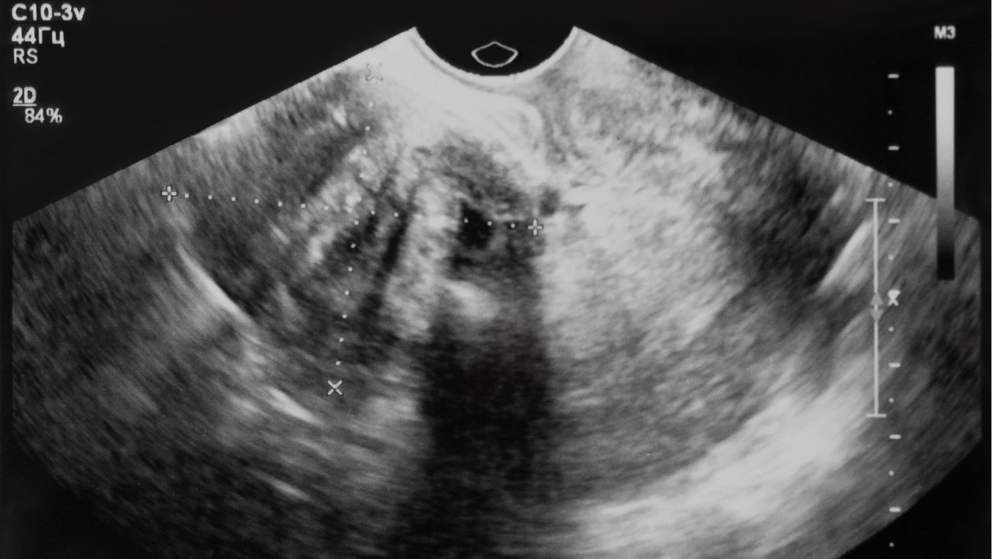 Miomas o Fibroides Uterinos