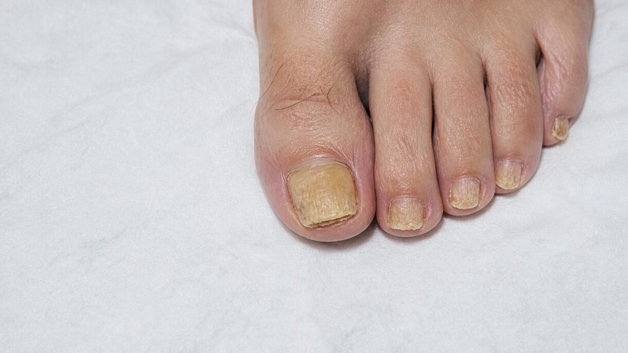 Onicomicosis: hongos en las uñas de los pies