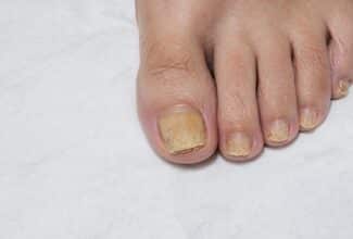 Onicomicosis: hongos en las uñas de los pies