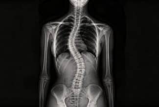 Escoliosis tras la menopausia: señales y factores de riesgo