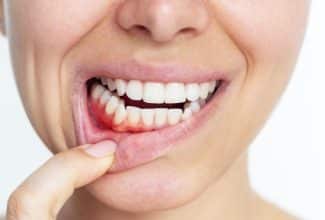 Gingivitis: la inflamación de las encías