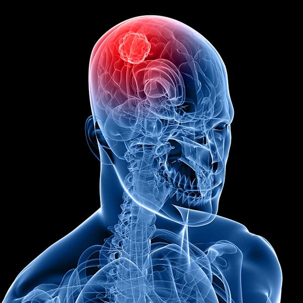 cáncer cerebral
