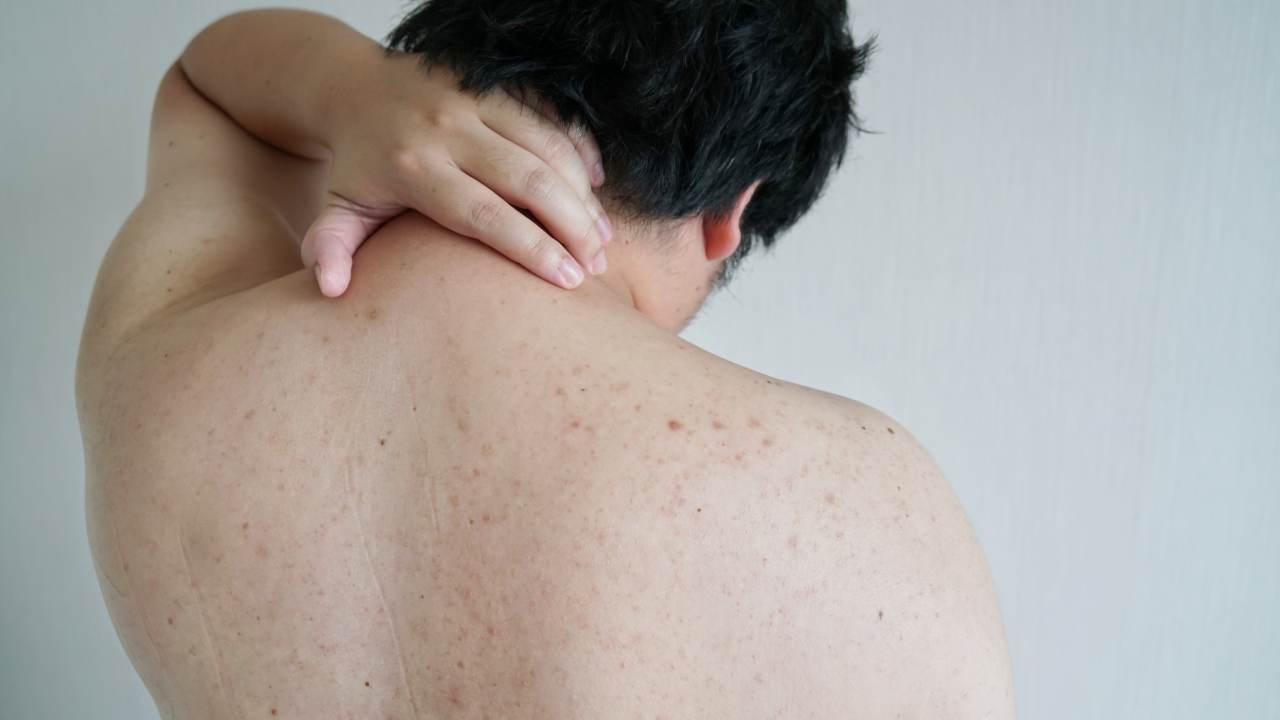 10 consejos para aliviar el acné en el cuerpo