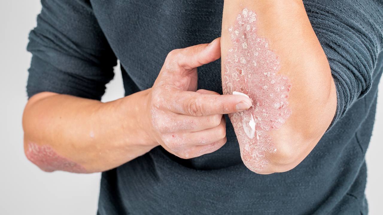Consejos diarios para el cuidado de la psoriasis