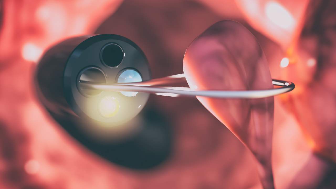 Gracias a la colonoscopía se reducen los casos de cáncer de colon