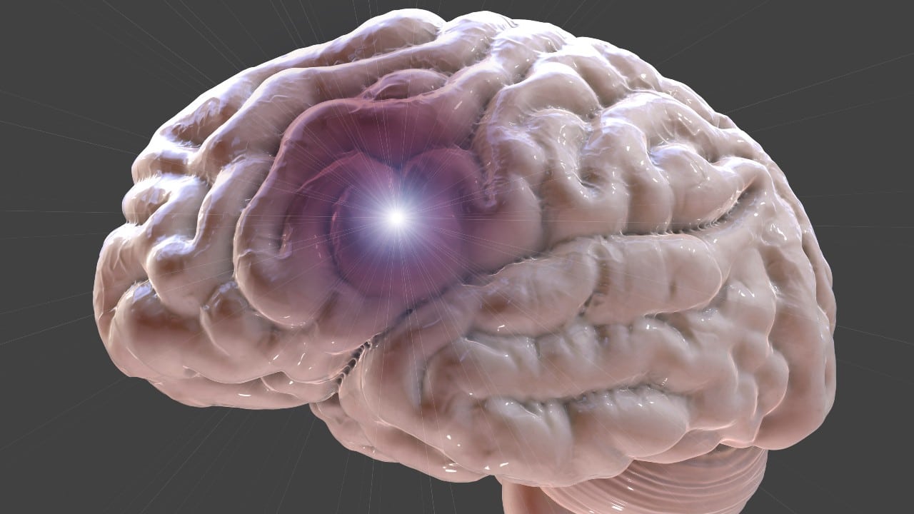 Aprende a reconocer los síntomas de una embolia cerebral