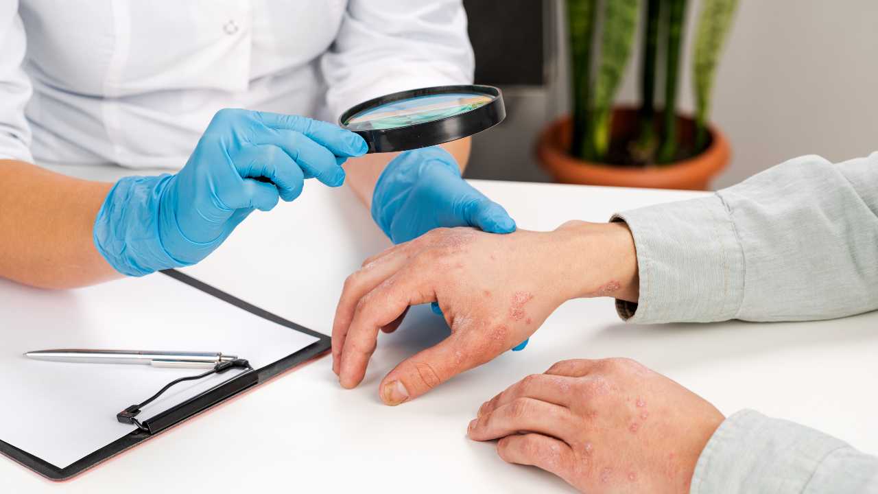 ¿Cuál es el tratamiento para la psoriasis?