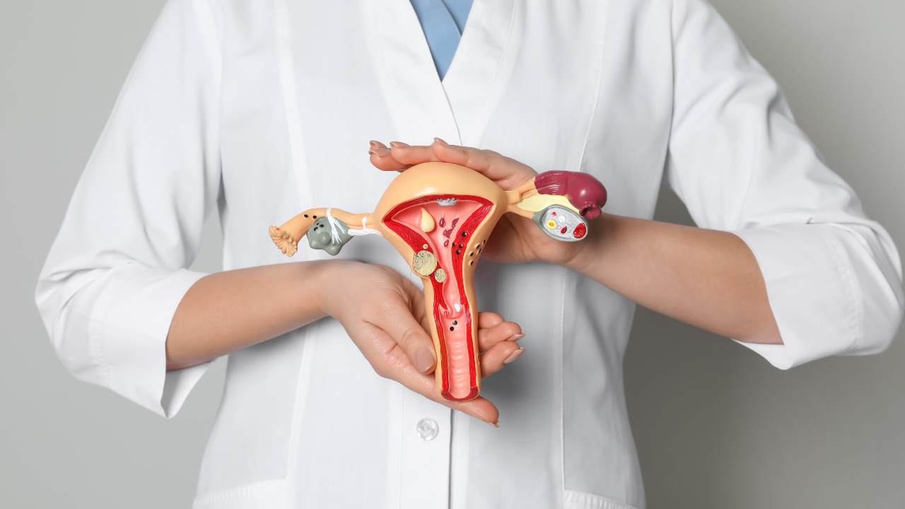 ¿Sabes qué es la endometriosis?
