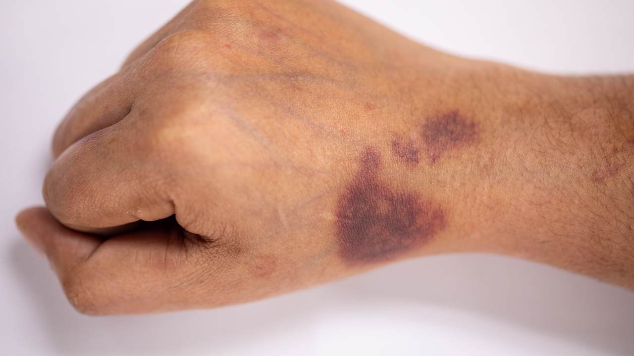 La hemofilia: la enfermedad de la realeza
