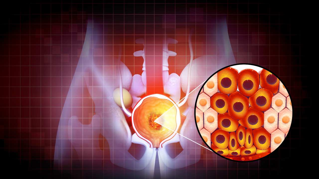 ¿Qué es la hiperplasia benigna de próstata?