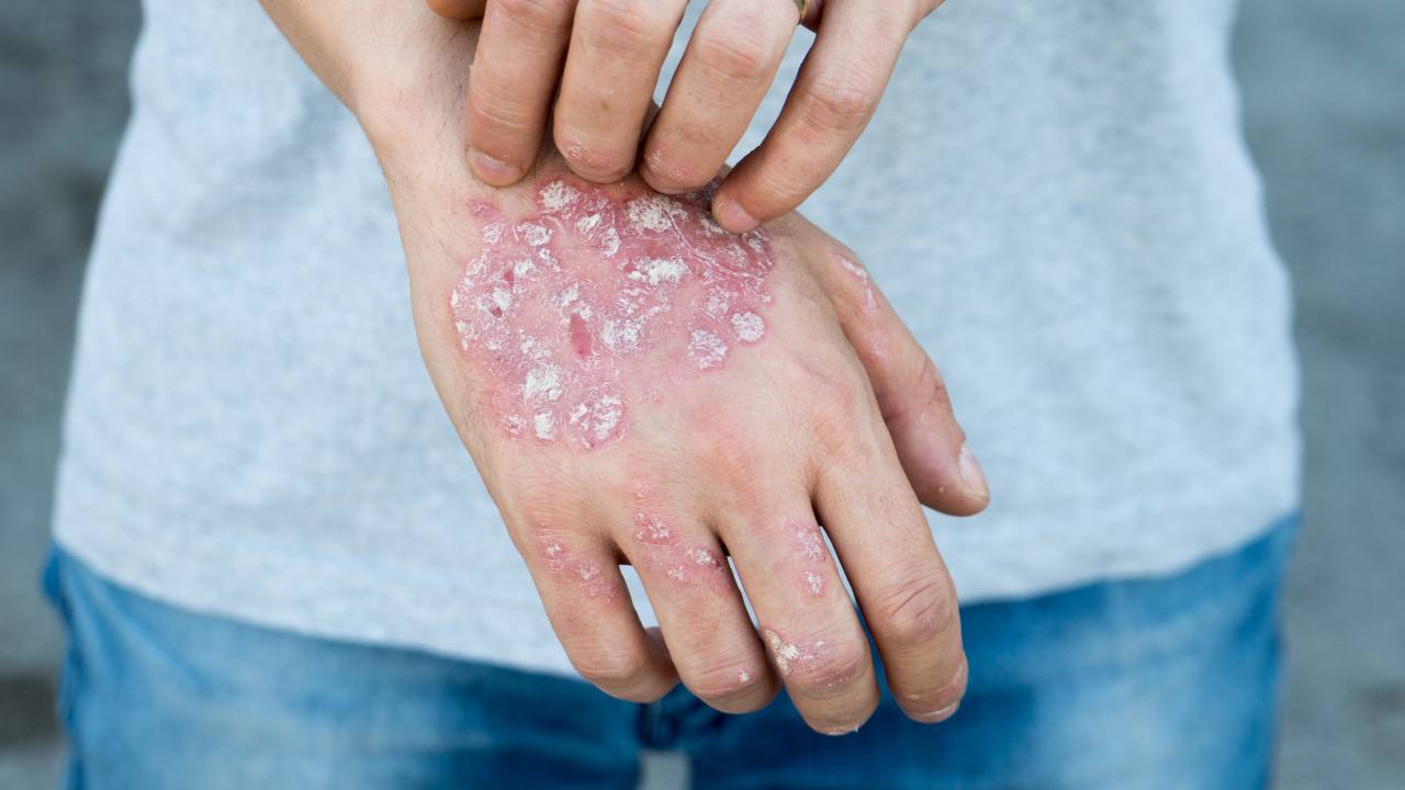 Cinco mitos y cinco verdades sobre la psoriasis