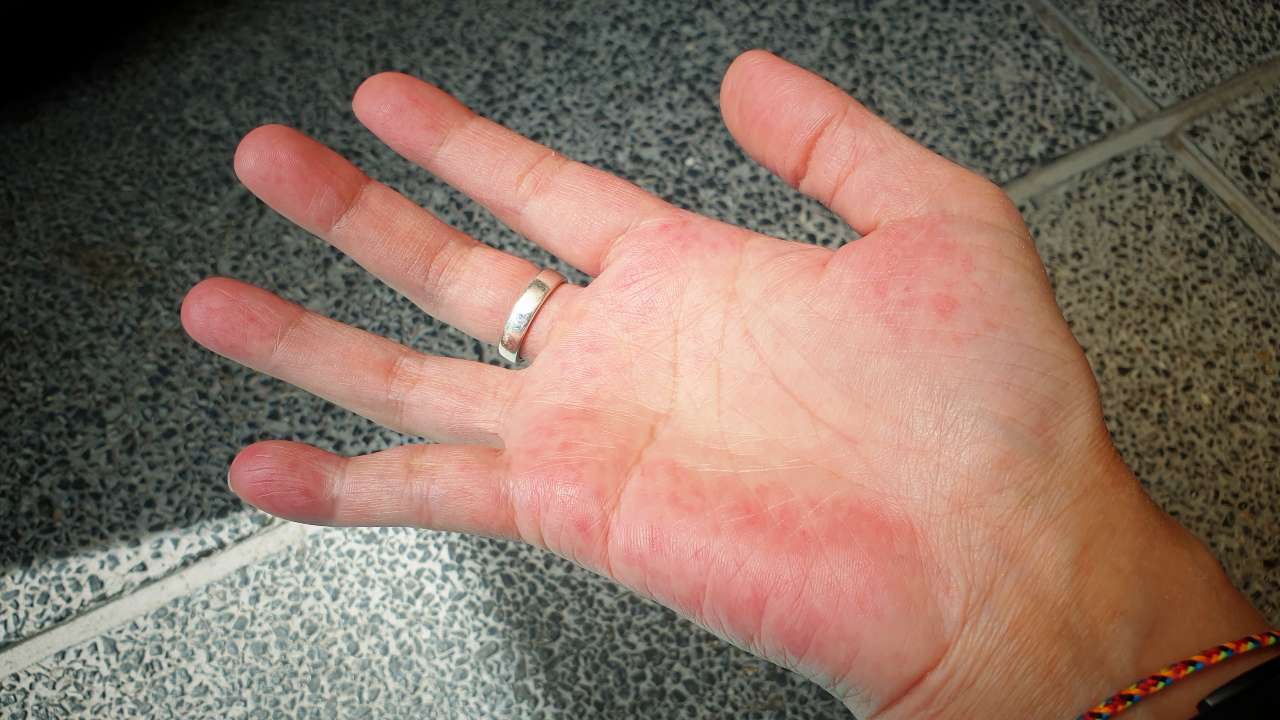 Lupus: Una enfermedad cada vez más entendida