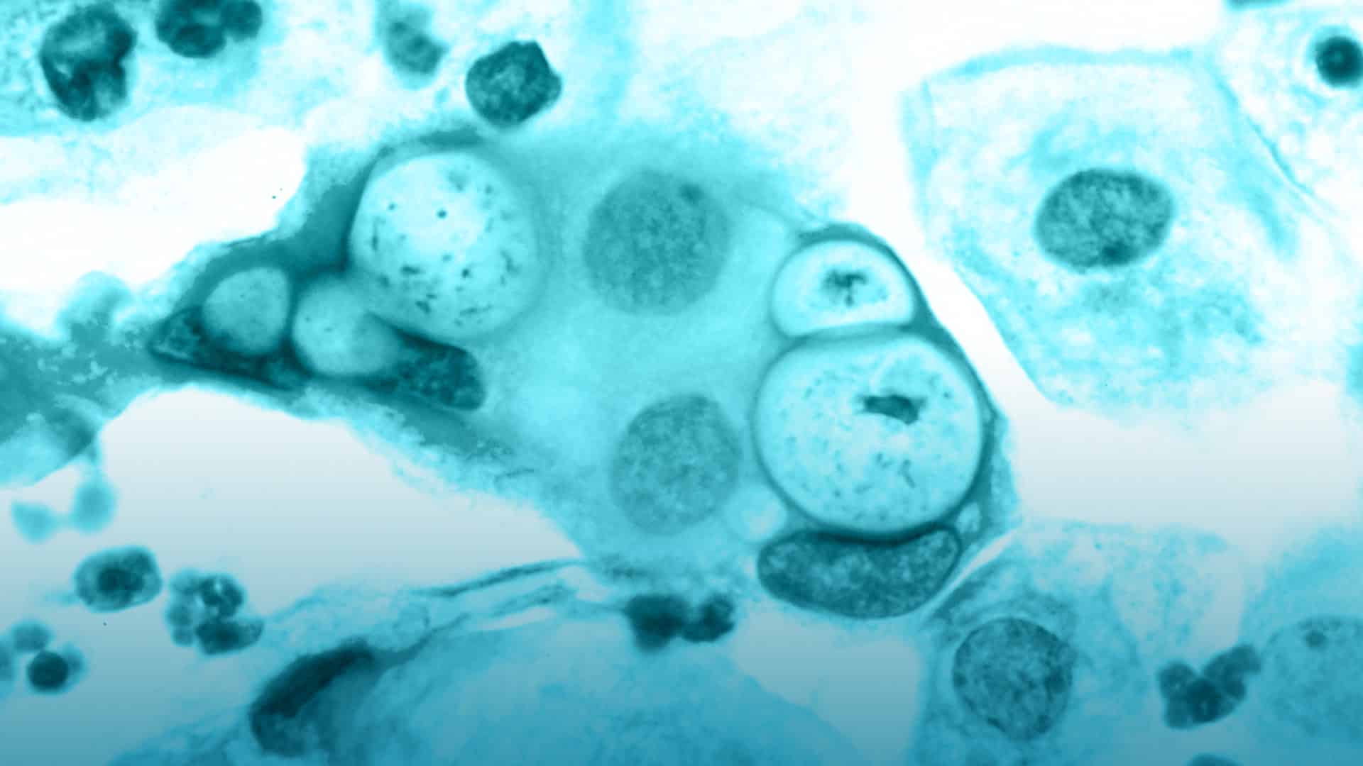 Cura en contra de la clamidia y sus peligros ocultos