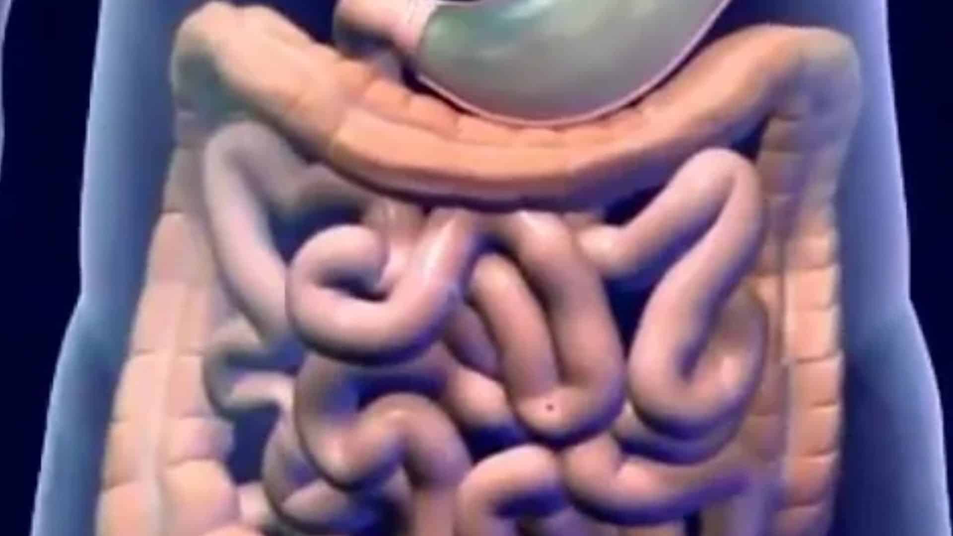 Enfermedad de Crohn, síntomas y tratamiento