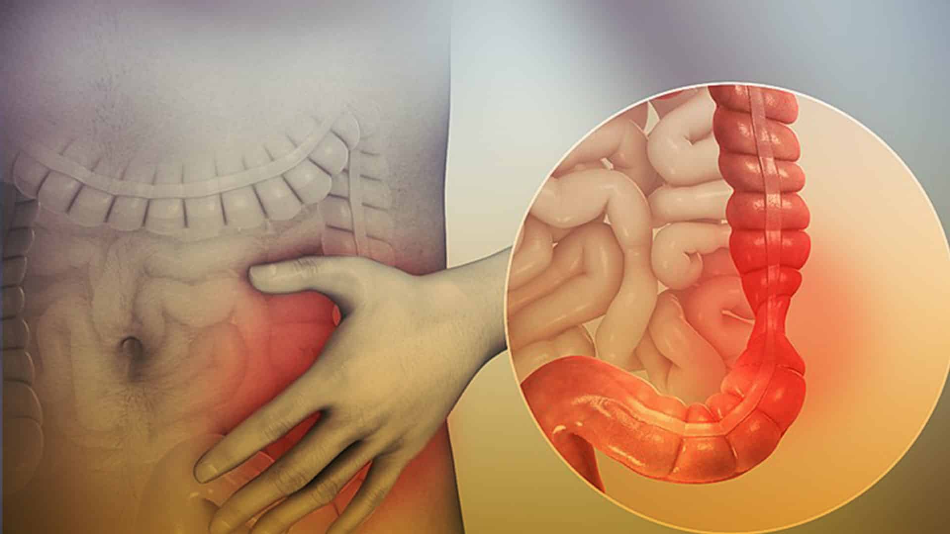Síndrome de intestino irritable