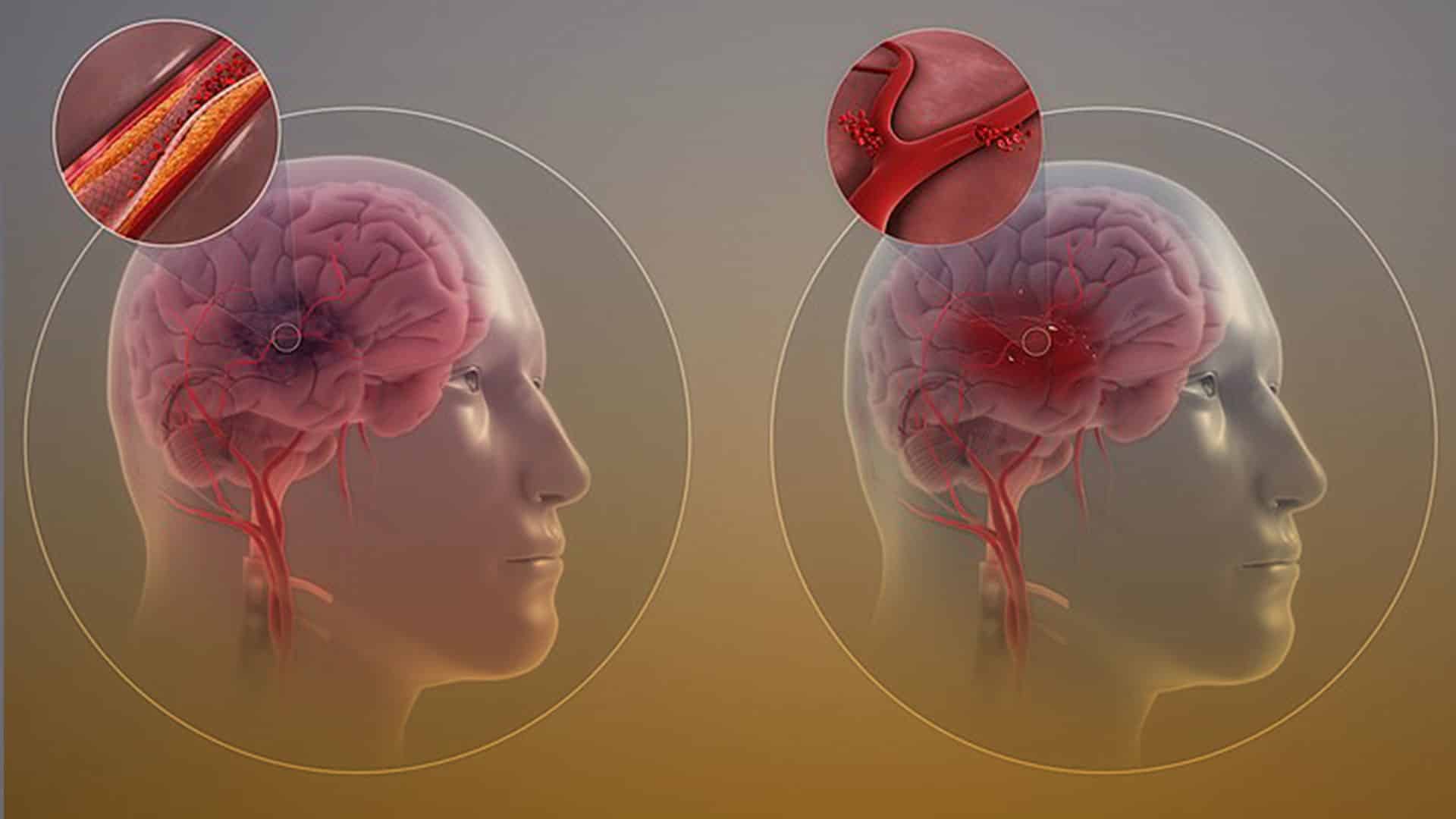 Prevención de infarto cerebral