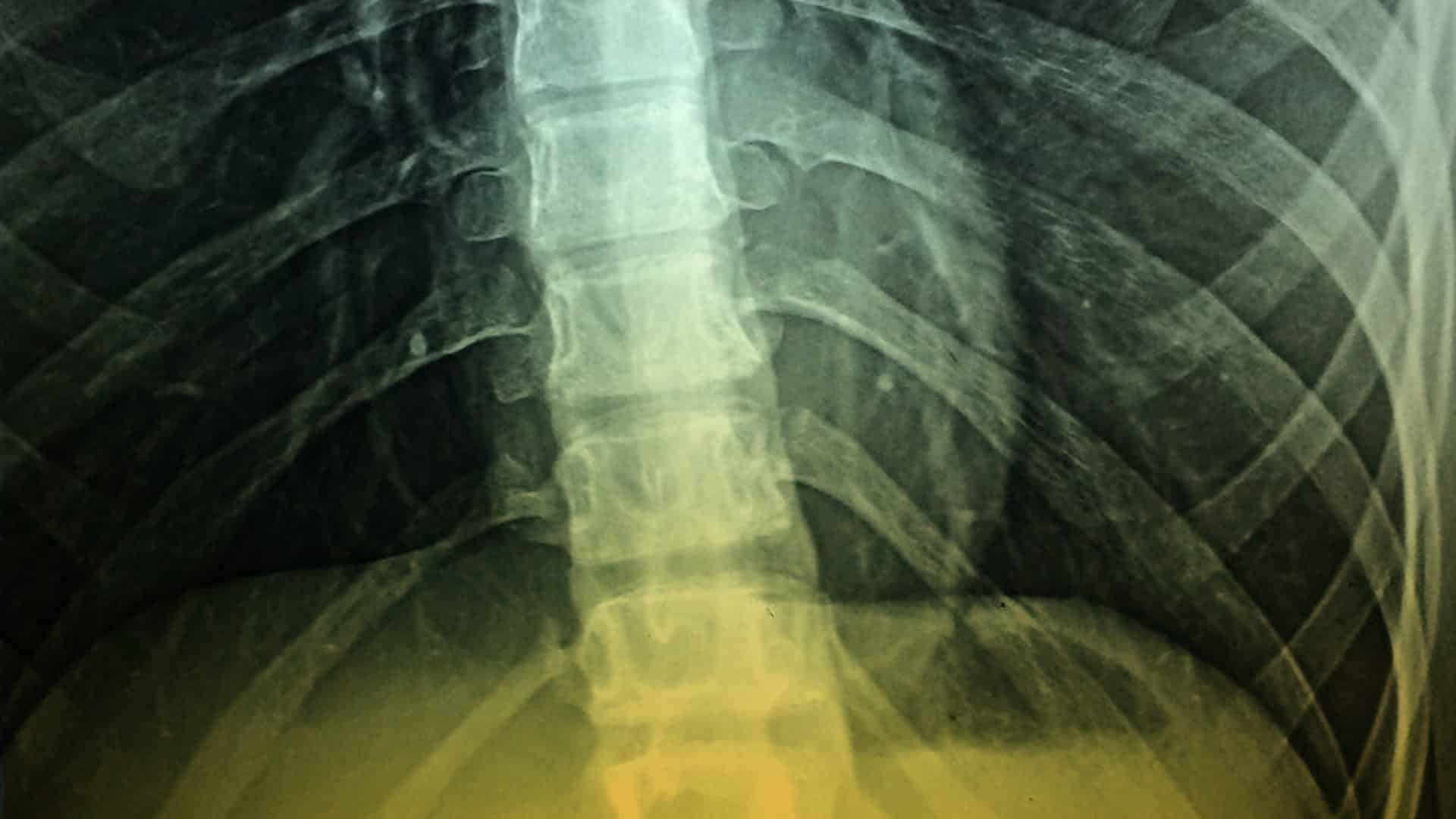 Usando un imán para estimular la médula espinal para pacientes con problemas