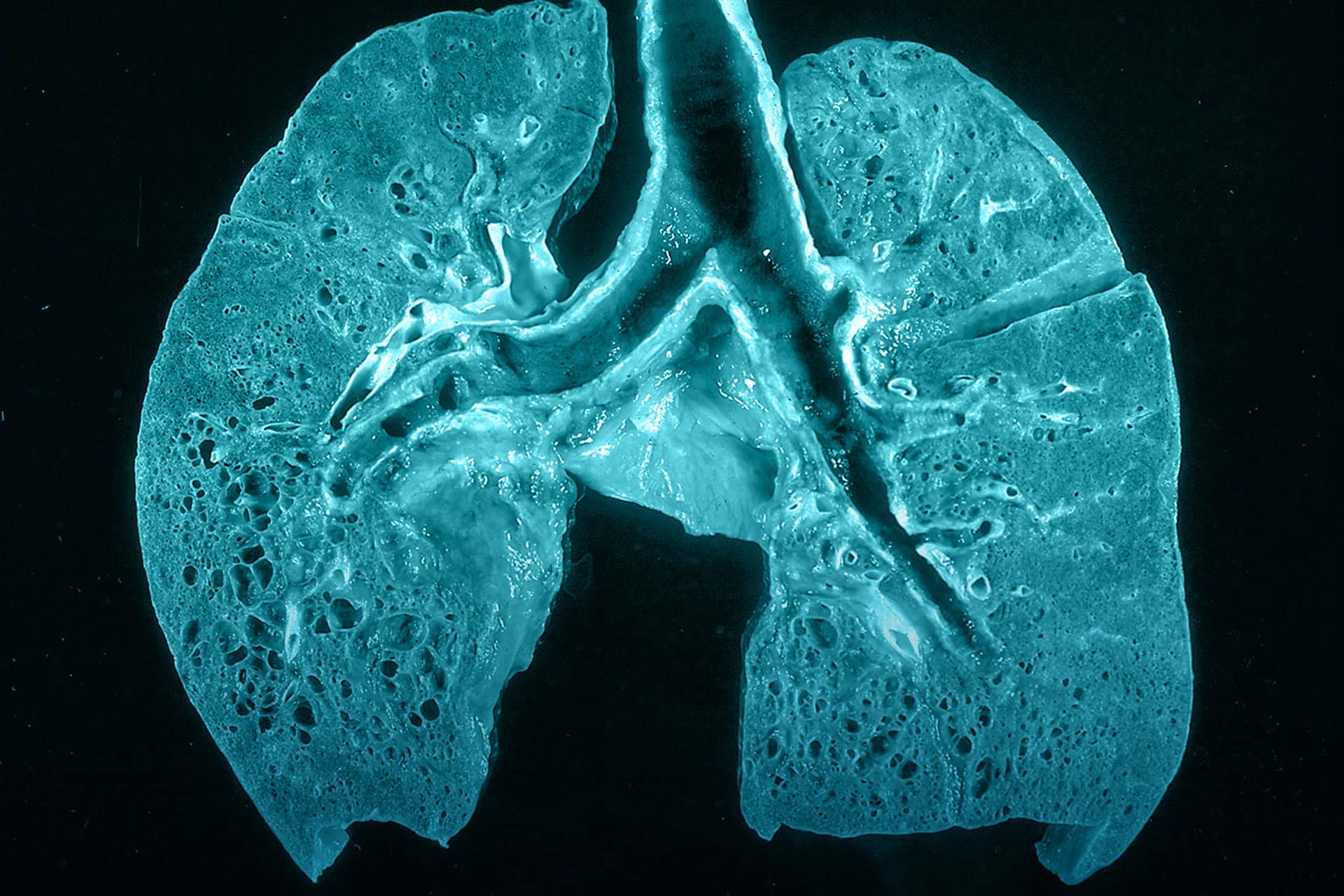 ¿Qué es la fibrosis pulmonar?