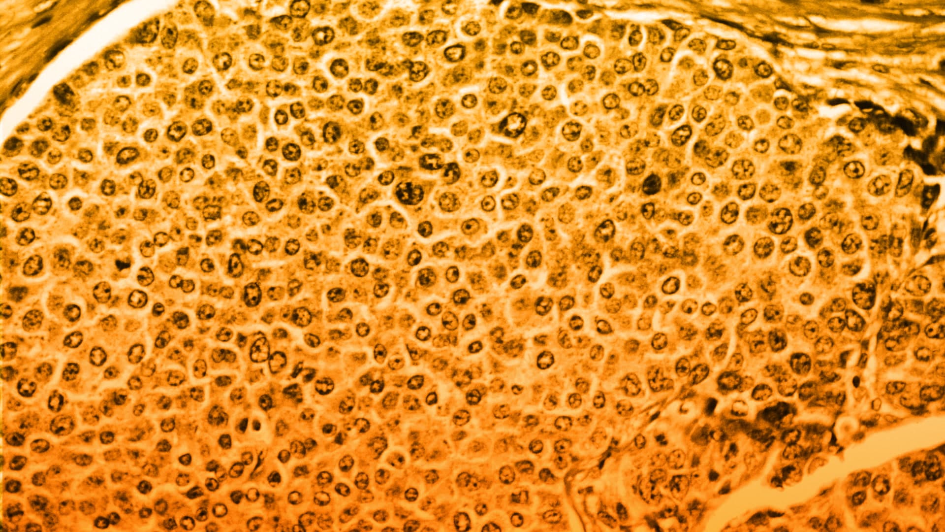 Polvo para heridas XCelliStem sana heridas después de una mastectomía bilateral