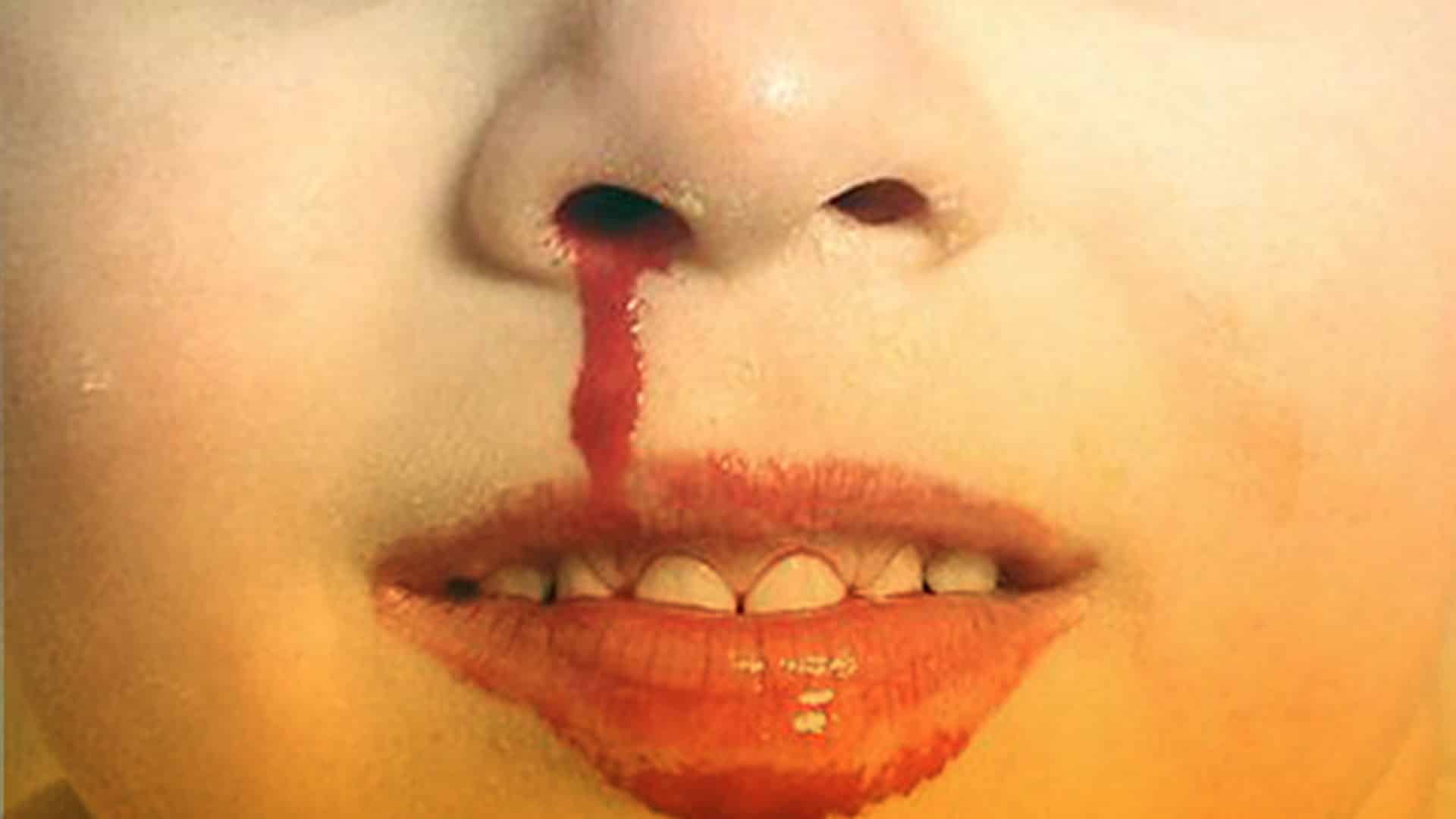 Epistaxis