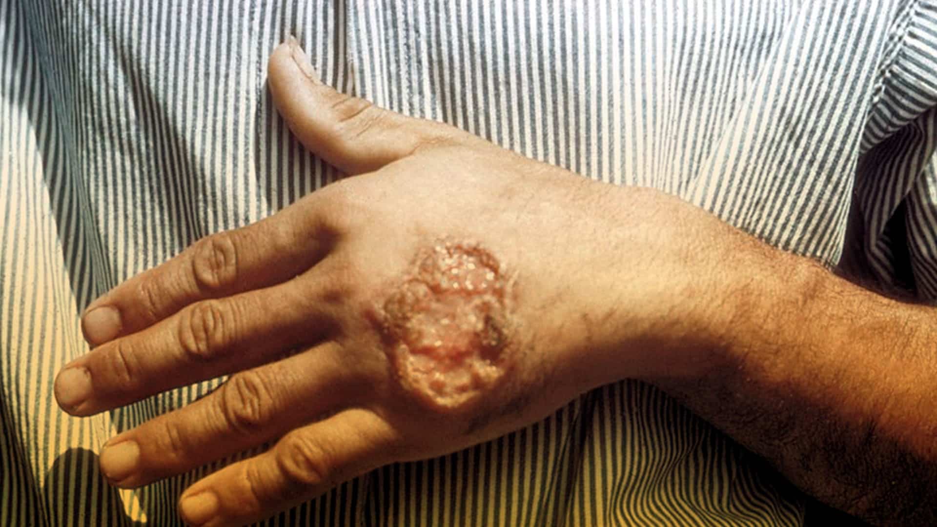 La leishmaniosis