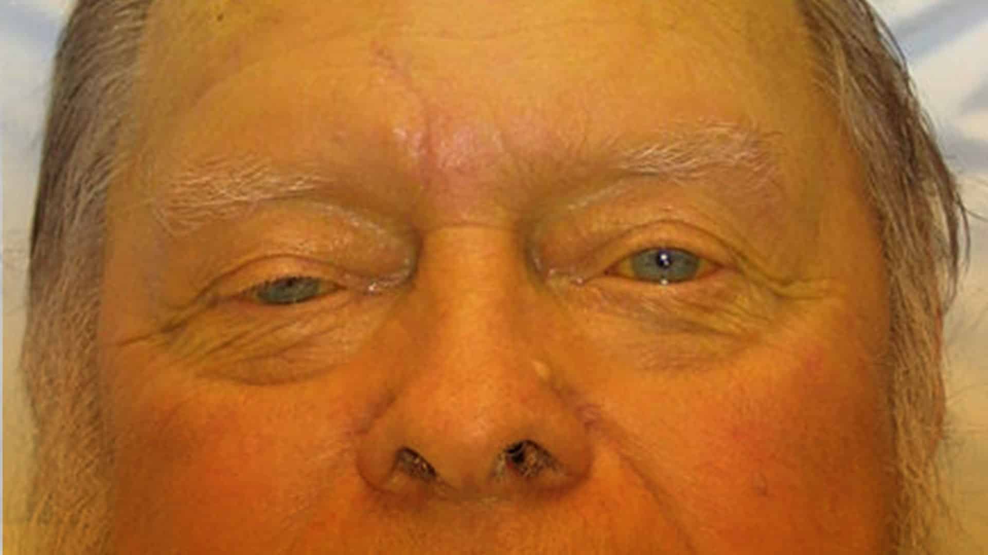 ¿Qué es la ictericia?