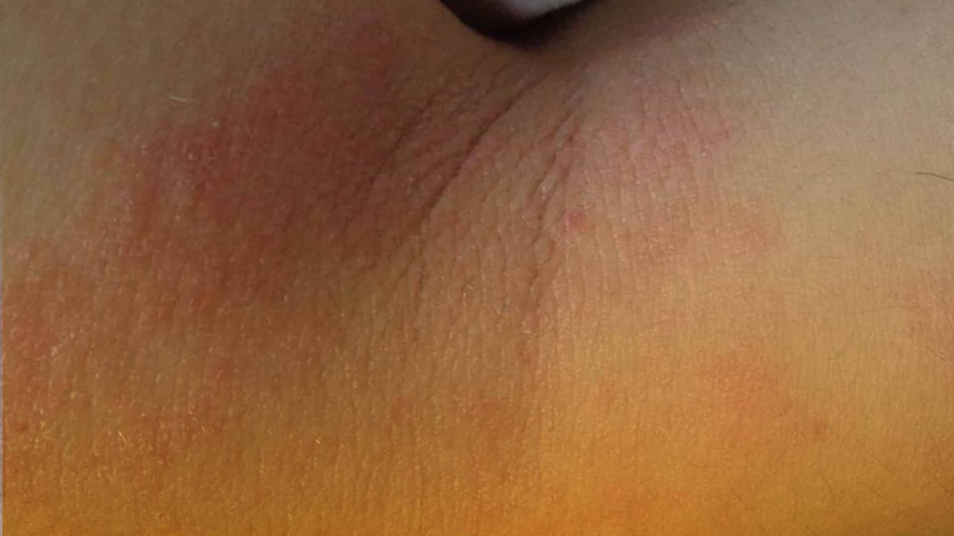 Causas de la dermatitis atópica