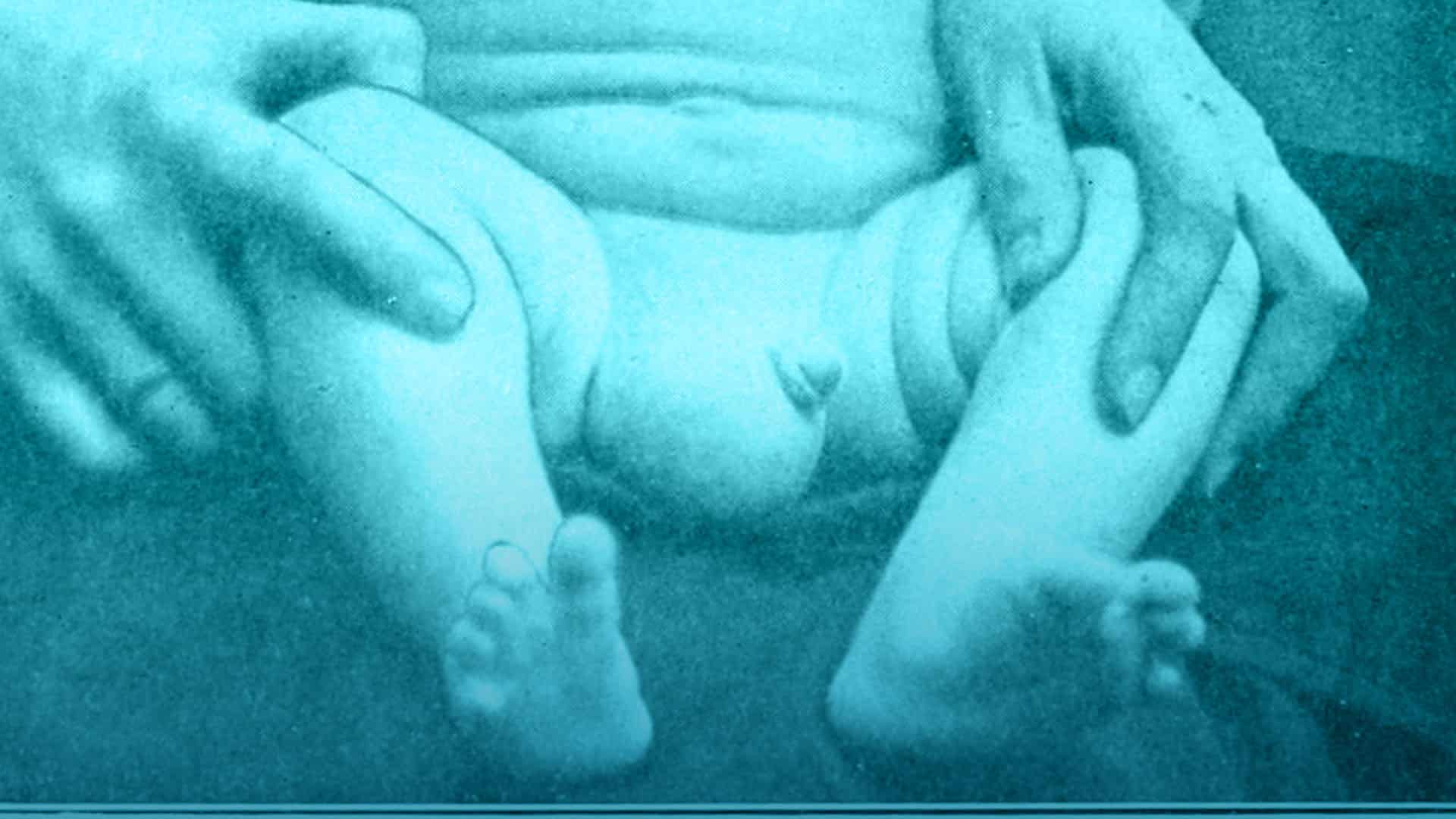 El testículo no descendido