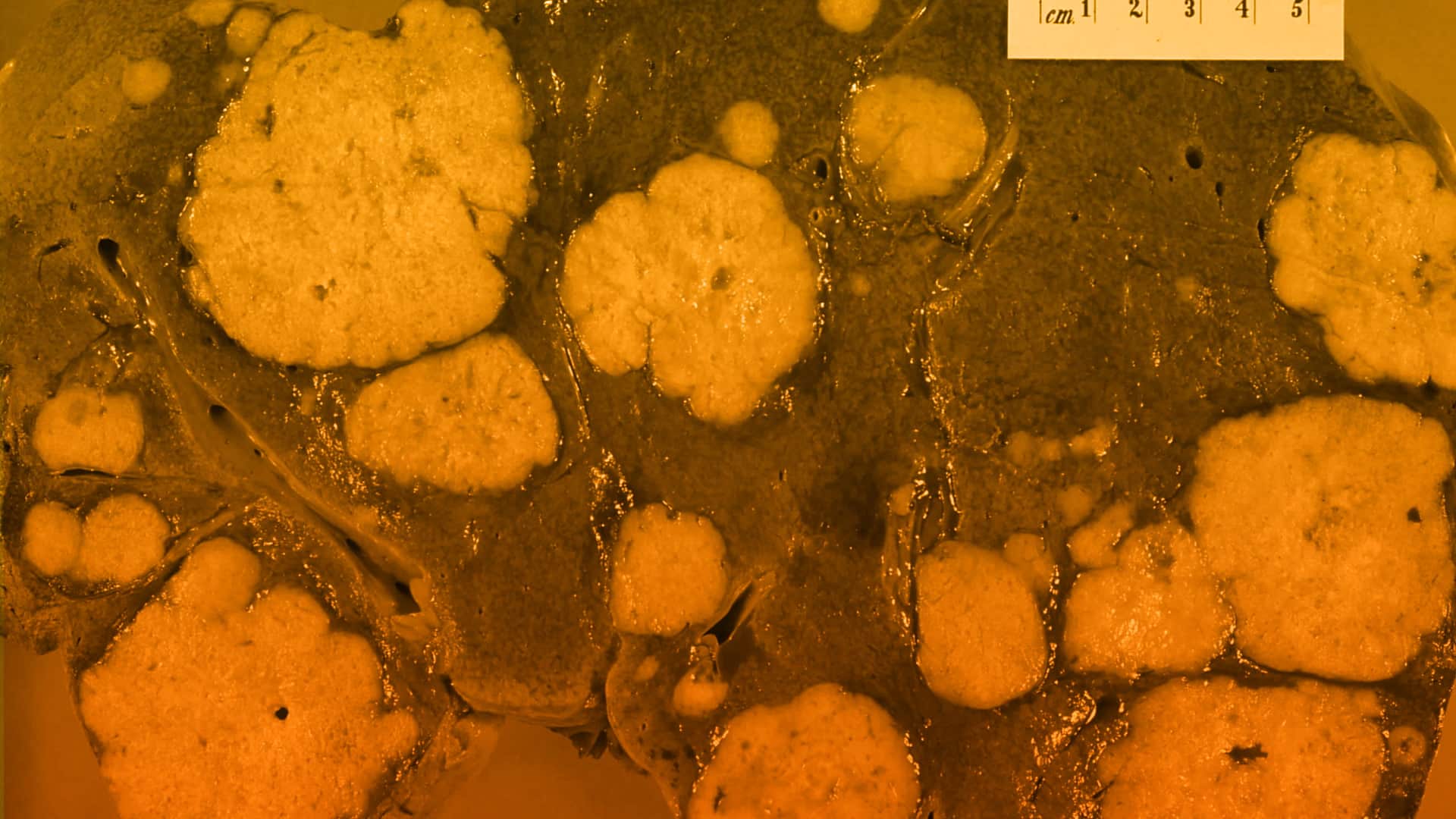 Protocolo para que los pacientes con cáncer colorrectal puedan recibir un transplante de hígado