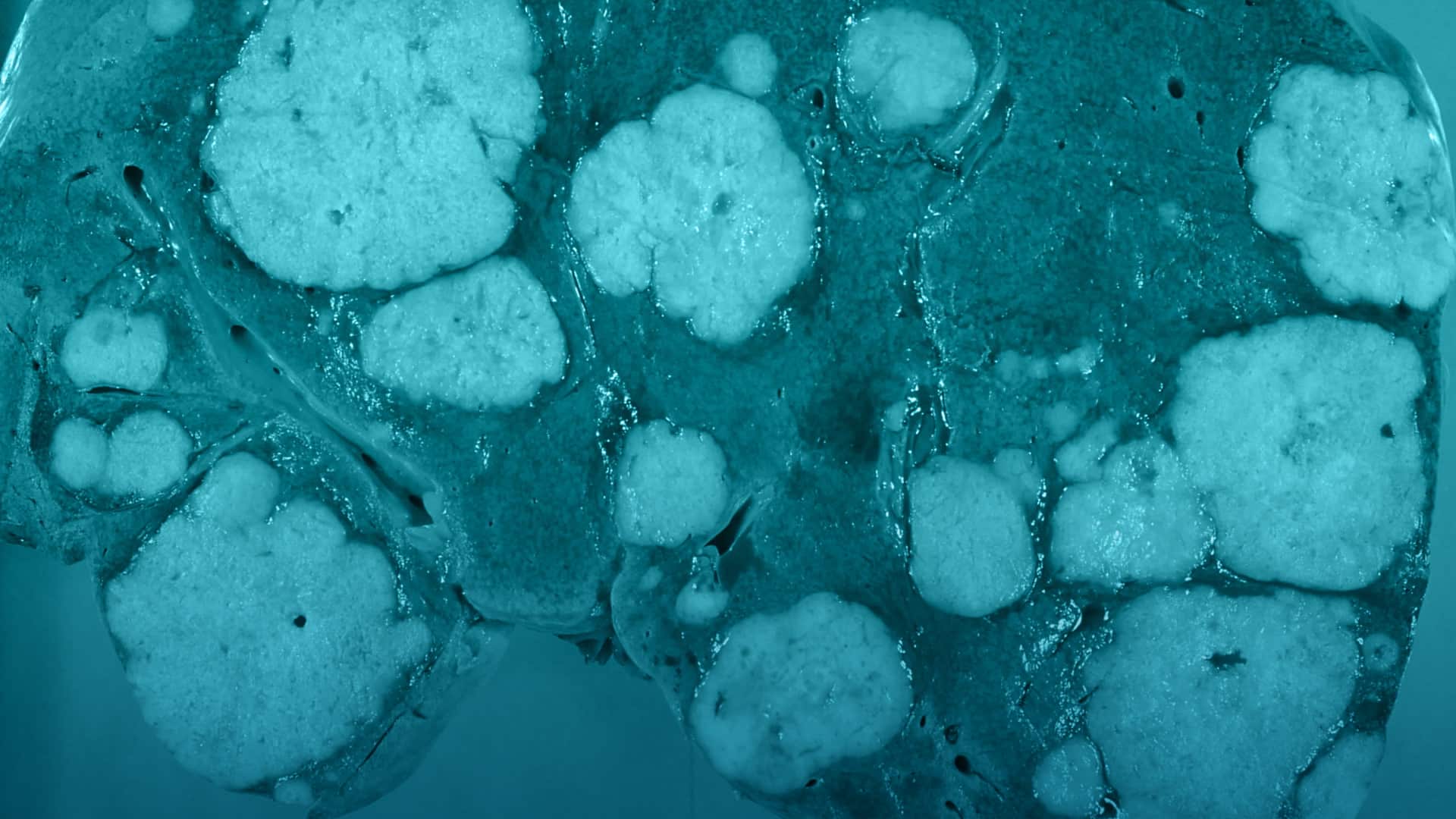 Explorar personas con hepatitis C para saber si tienen cáncer de hígado