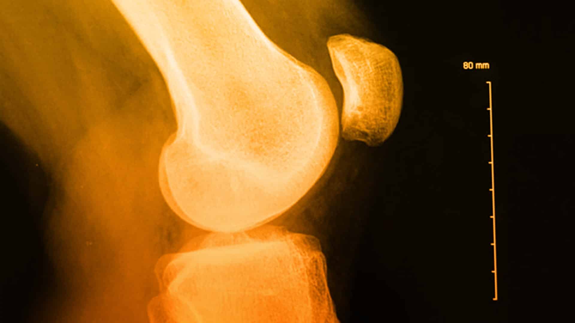 Lesiones de rodilla