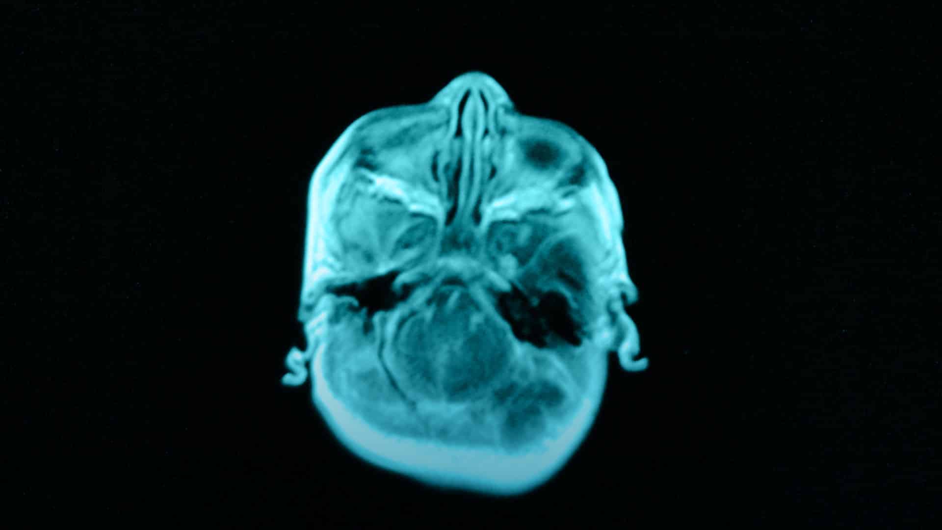 Contra todas las probabilidades: Malformación de Chiari