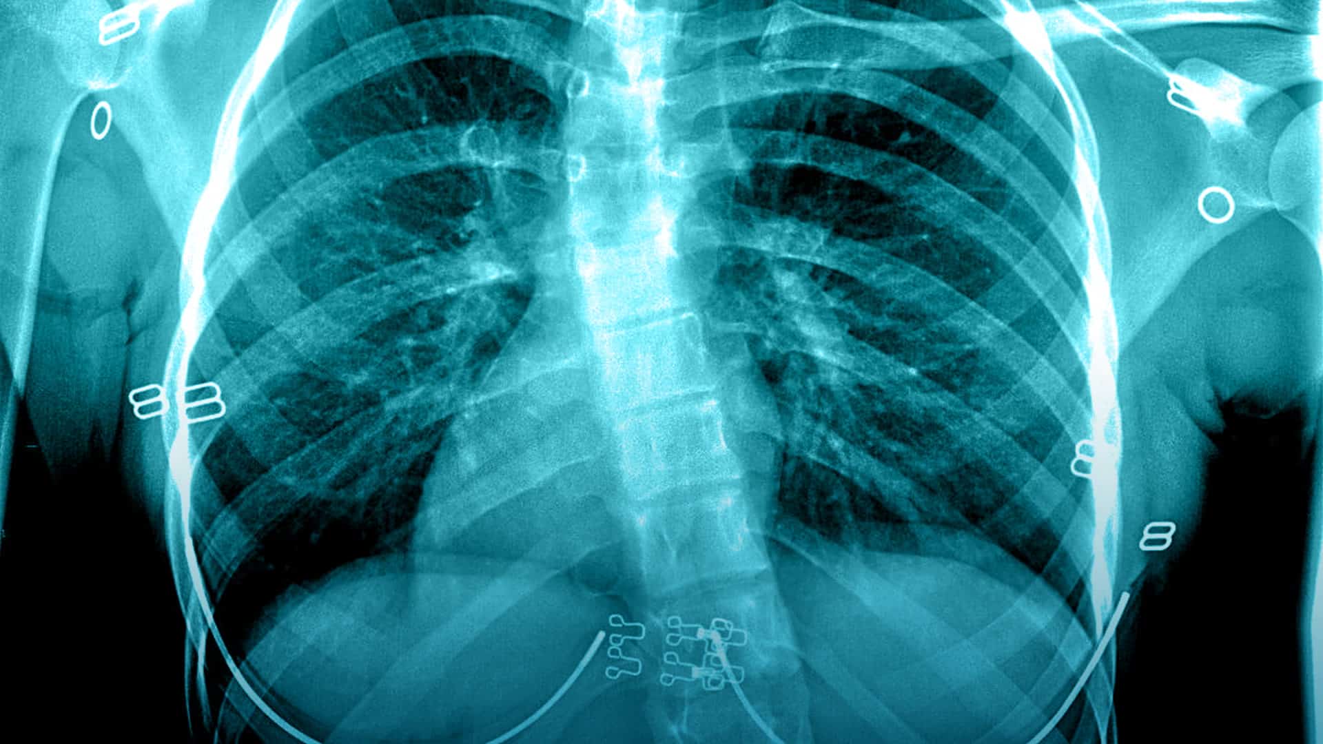 Hospital consigue desarrolla un nuevo tratamiento para la escoliosis con éxito