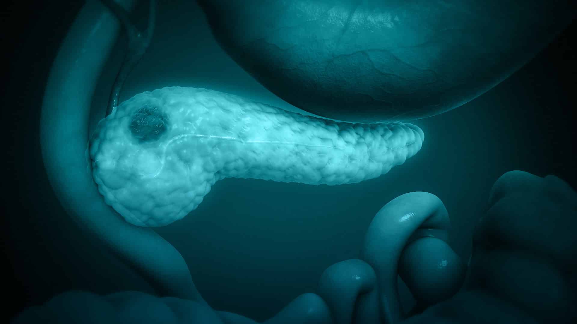 Imitando cáncer de páncreas de humanos en ratones para encontrar su cura