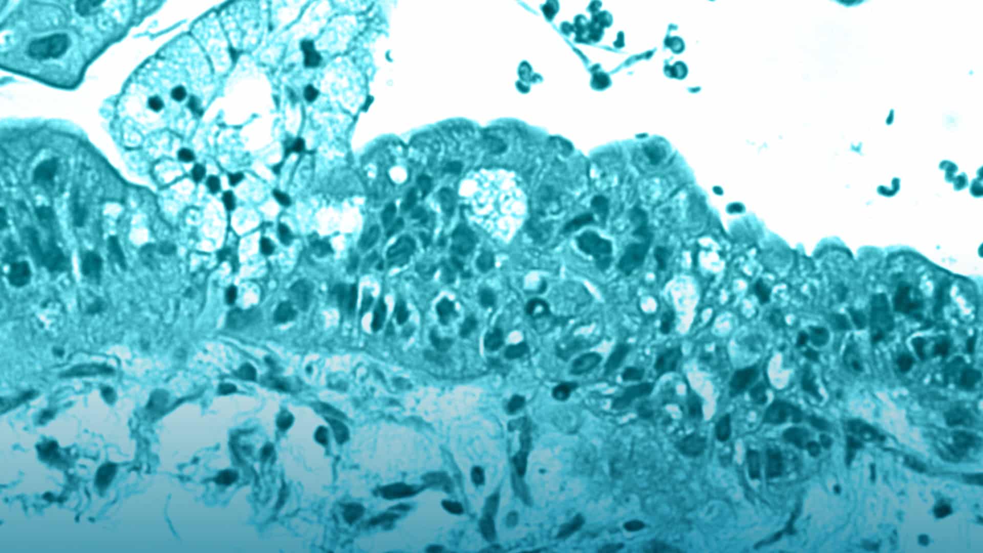 Cirugía HIPEC para tratar el cáncer de ovario en fase avanzada