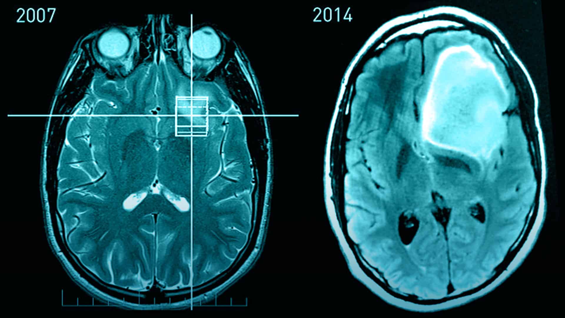 Causas de los tumores cerebrales